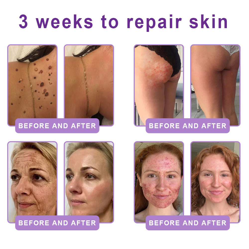 FDA Official: HISKIN® PDRN Multi-Peptide Massaging Body Roller Cream- Anti-aging, Hydrating, Skin Firming & Lifting, Skin Repair, Even Tone, Acne and Dark Spot Treatment, Wart and Mole Removal, and Psoriasis Relief.