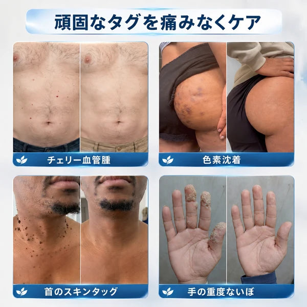 5日で効果を実感 ― Hiskin® 2-in-1 マイクロニードル・ハイドロコロイドパッチ：肌の気になる箇所をケアする、痛みや跡が残らない高品質なパッチです。