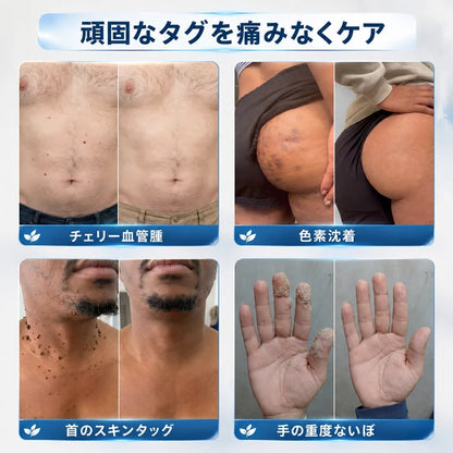 5日で効果を実感 ― Hiskin® 2-in-1 マイクロニードル・ハイドロコロイドパッチ：肌の気になる箇所をケアする、痛みや跡が残らない高品質なパッチです。