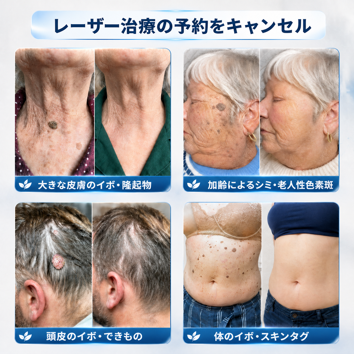 🎮薬剤師もおすすめ HISKIN® 7日間 タグ＆スポットイレーサー🪄 （痛みゼロ・傷あとゼロを目指すローラーボールタイプ）👩‍⚕️