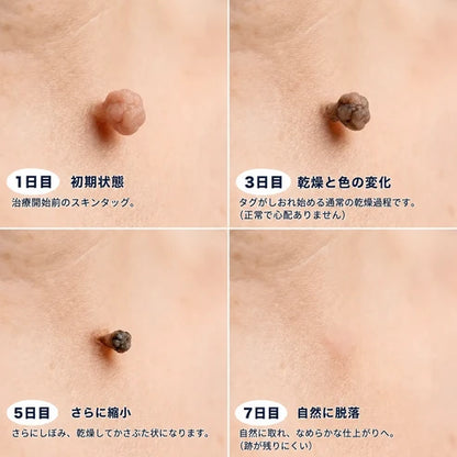 5日で効果を実感 ― Hiskin® 2-in-1 マイクロニードル・ハイドロコロイドパッチ：肌の気になる箇所をケアする、痛みや跡が残らない高品質なパッチです。
