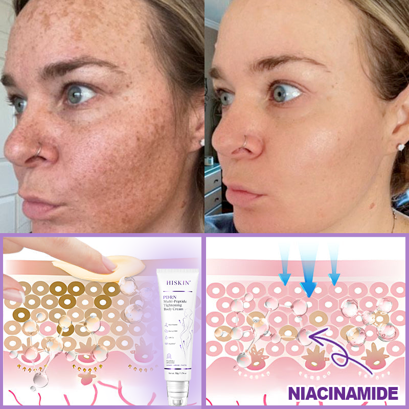 FDA Official: HISKIN® PDRN Multi-Peptide Massaging Body Roller Cream- Anti-aging, Hydrating, Skin Firming & Lifting, Skin Repair, Even Tone, Acne and Dark Spot Treatment, Wart and Mole Removal, and Psoriasis Relief.