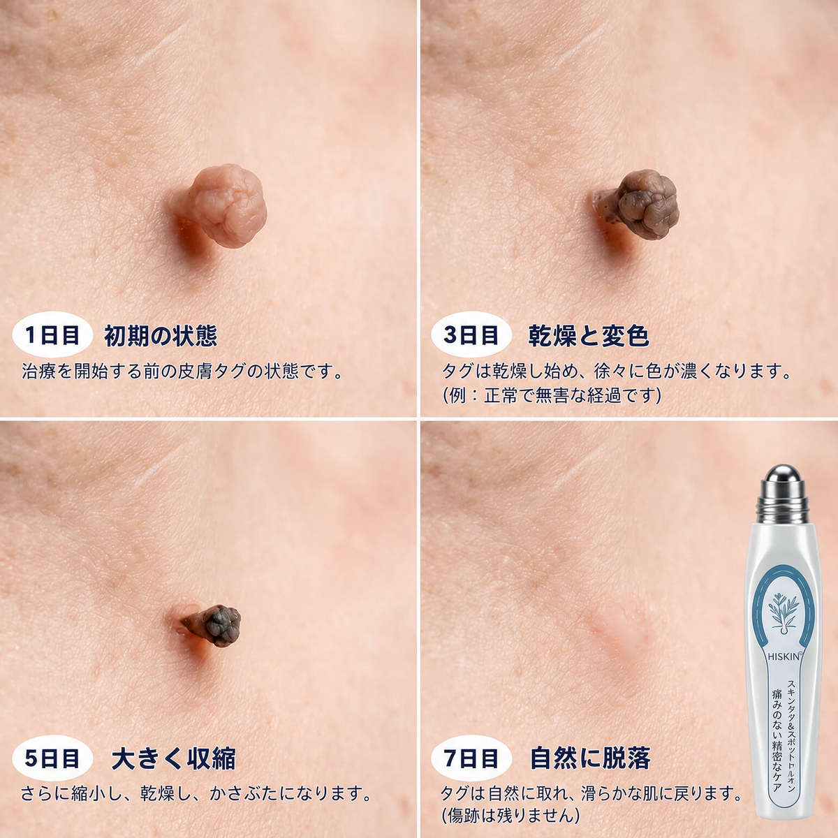 🎮薬剤師もおすすめ HISKIN® 7日間 タグ＆スポットイレーサー🪄 （痛みゼロ・傷あとゼロを目指すローラーボールタイプ）👩‍⚕️
